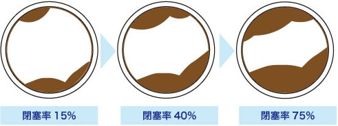 水道管の経年劣化